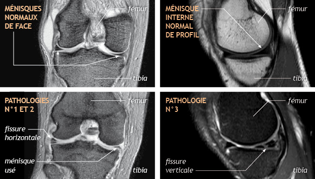 Ménisque - Clinique du sport
