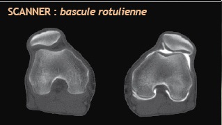 Rotule - Clinique du sport