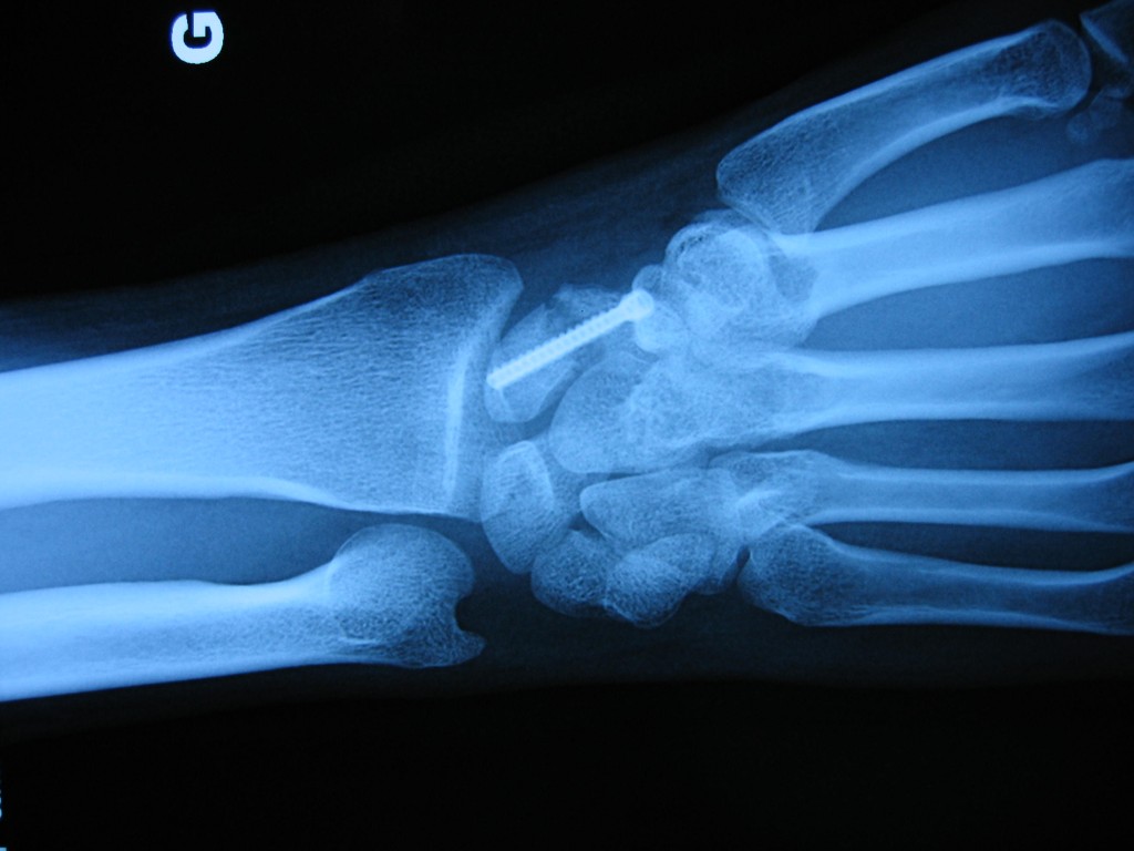 Fracture du scaphoïde Clinique du sport