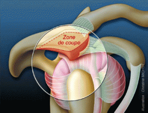 Trait-tendinopathie-1