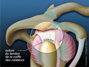 Trait-tendinopathie-3