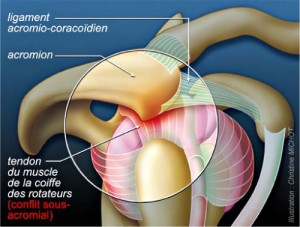 tendinopathie-2