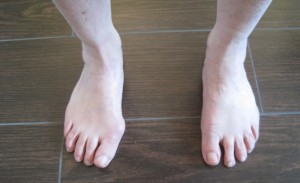Hallux-Valgus