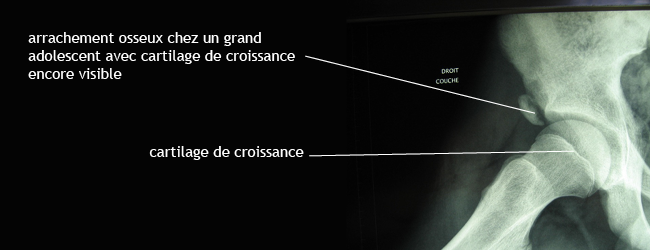 arrachement_radio_illus_epine