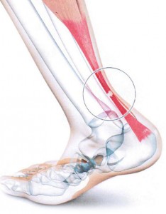 diagnostic-tendon-achille-anatomie