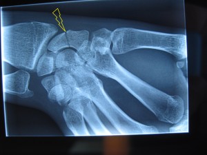 fracture tiers moyen du scaphoïde