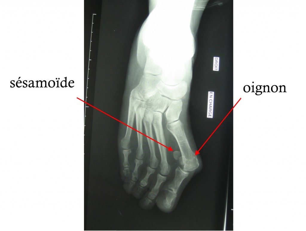 hallux-valgus-radio