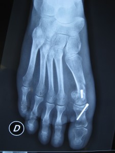 Hallux Valgus - Clinique du sport