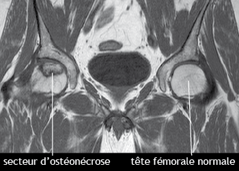 ostheonecrose_irm_illus_necrose2