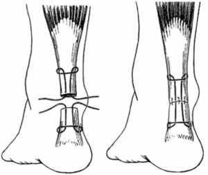 traitement-rupture-tendon_reparation-du-tendon-d-achille-2