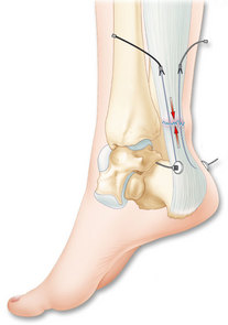 traitement tendon-achille-tenolig